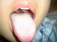 知名中医全面揭秘舌苔厚白的症状