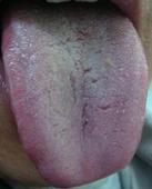 舌苔与脾胃息息相关