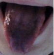 舌苔发黑是什么情况