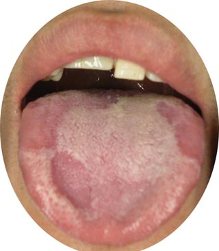 辨证分析舌苔异常