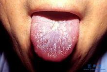 看舌苔辨健康与否