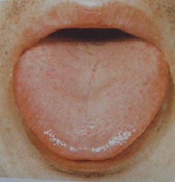 舌苔异常饮食需对症