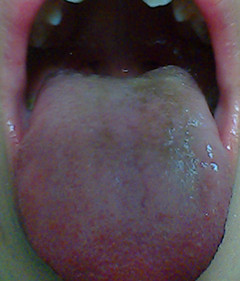 舌苔异常说明什么问题